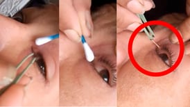 Mujer muestra en TikTok la forma en que le sacaron un gusano del ojo