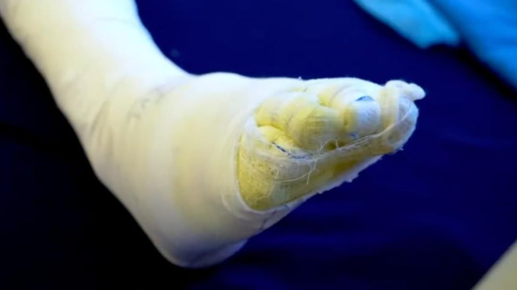 Asciende a 92 las personas quemadas con pólvora en Bogotá durante diciembre.