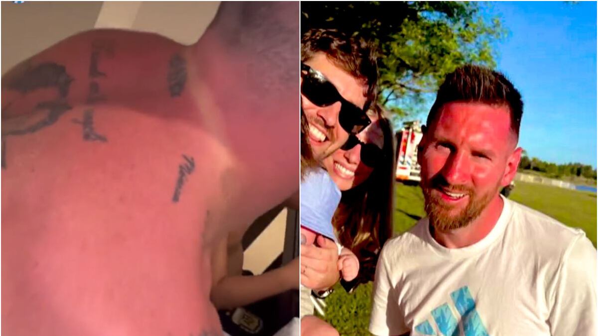 Messi y sus compañeros de Argentina se insolaron de manera terrible