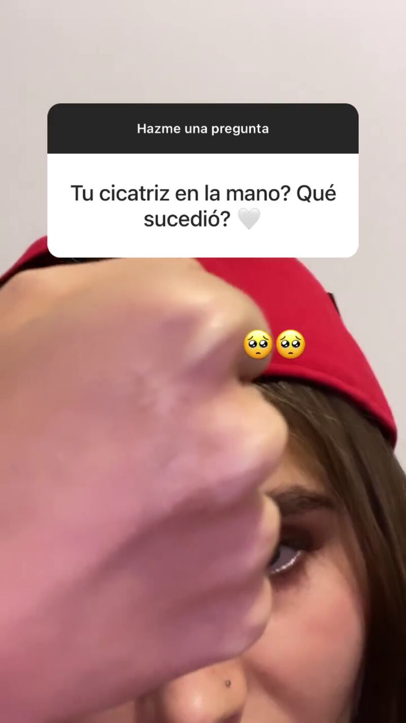 Shaira mostró la cicatriz de su mano