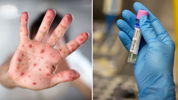 OMS alerta por viruela del mono