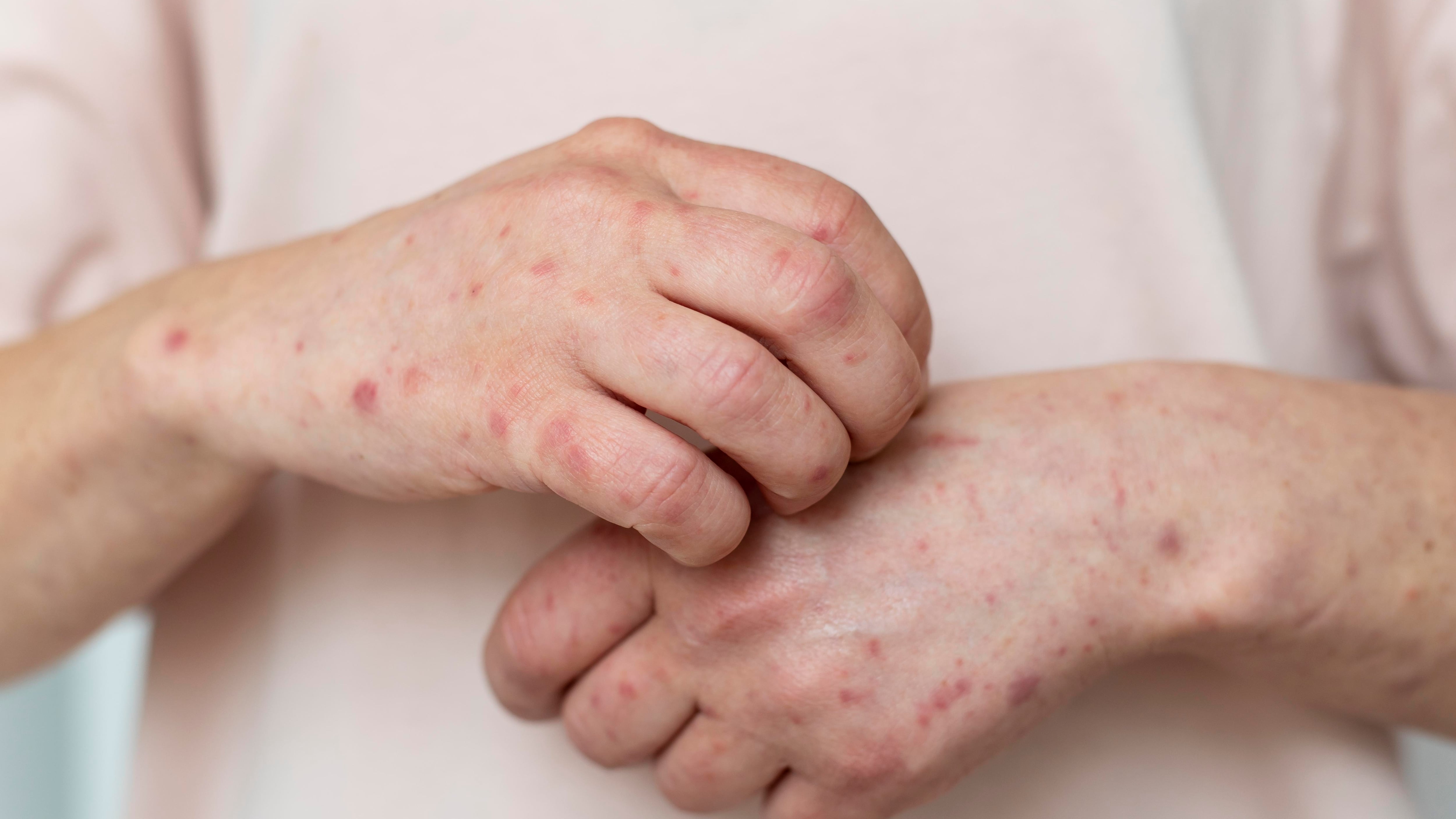 Sarampión en Colombia