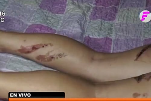 Brutal ataque a mujer por difundir un chisme: la sentaron en brasero hirviendo