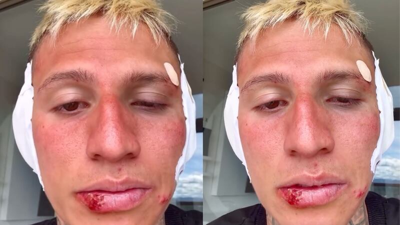 La Liendra preocupó a sus seguidores al aparecer con fuertes golpes en su rostro