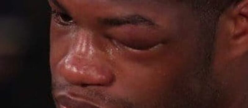 Girmay, cerca de decir adiós al Giro por el fuerte golpe en su ojo con el corcho