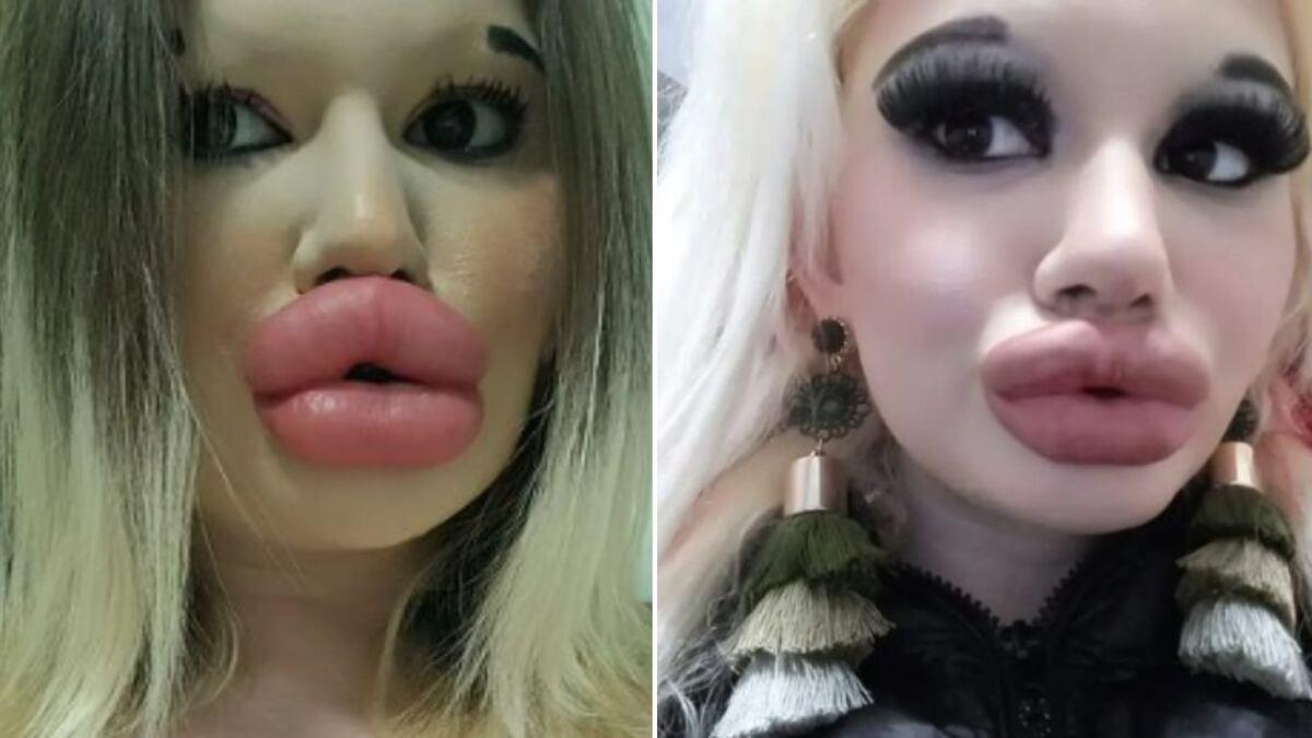 Andrea Ivanova, oriunda de Bulgaria quiere los labios y los pómulos más grandes del mundo