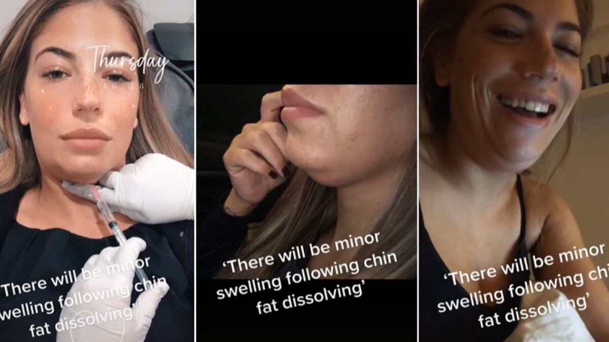 Deniz Valiantis, en su cuenta de TikTok, contó que se sometió a un tratamiento para eliminar la papada y no fueron los mejores resultados