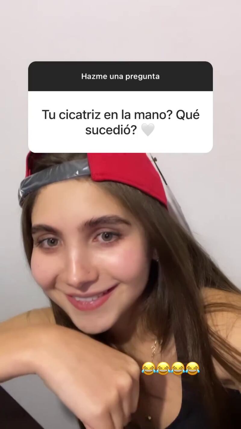 Shaira contó la historia detrás de la cicatriz de su mano