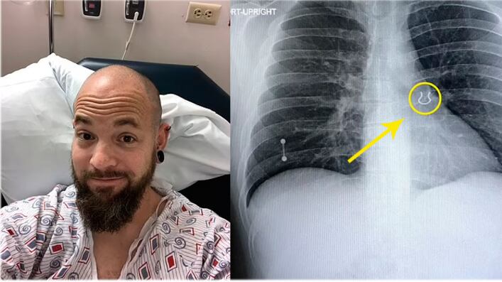 Piercing encontrado no pulmão do paciente