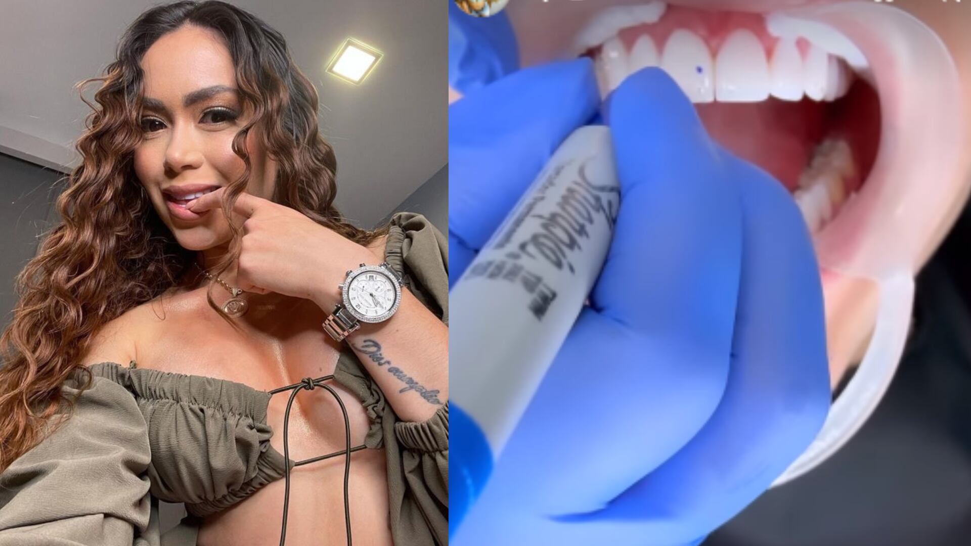 Epa Colombia se implantó 80 diamantes en los dientes