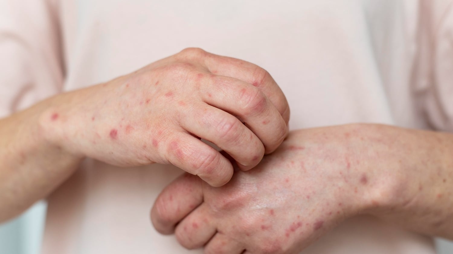 Querétaro registra 19 casos de sarampión