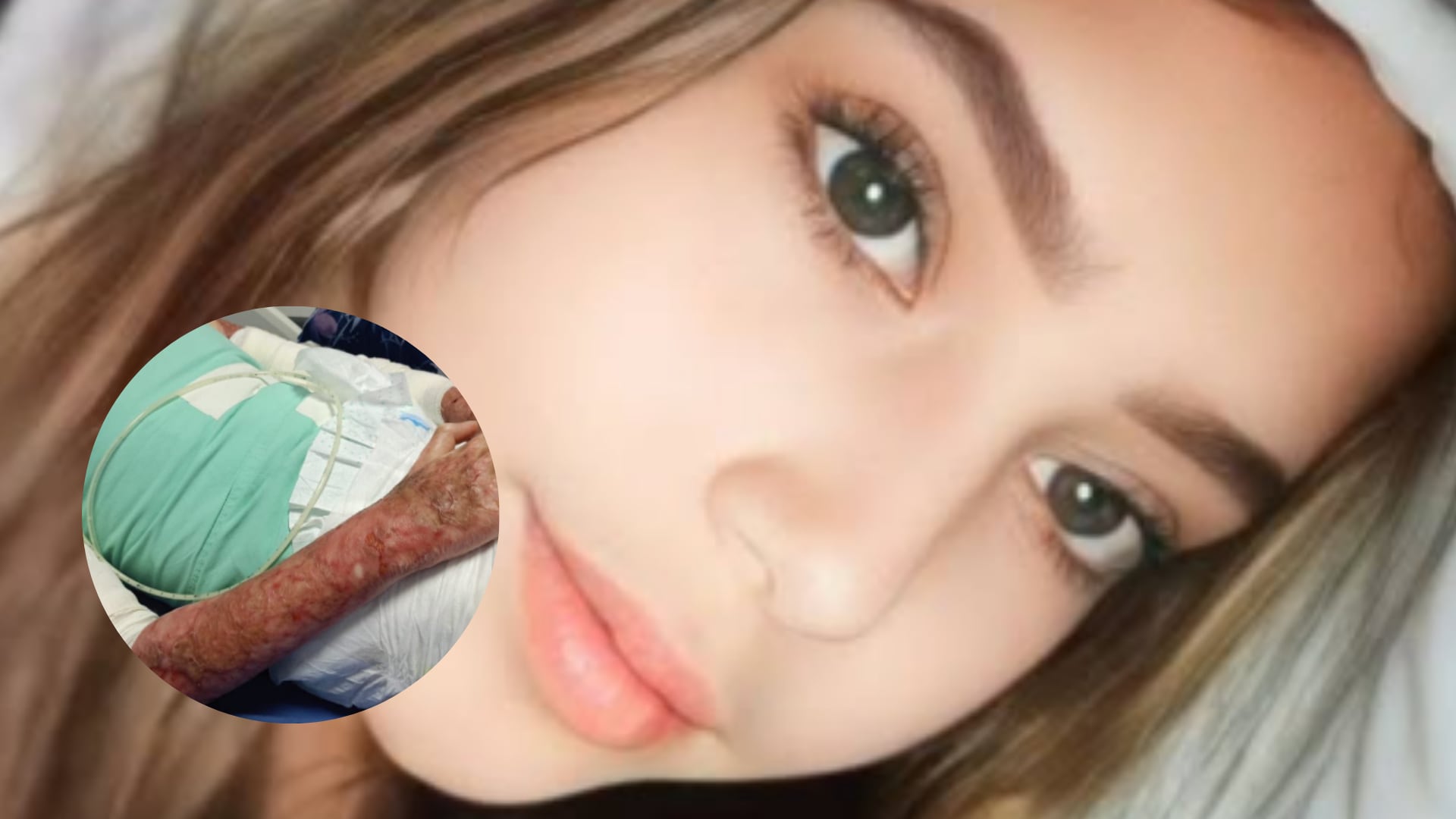 Quinceañera quemada en perfumería en Pasto