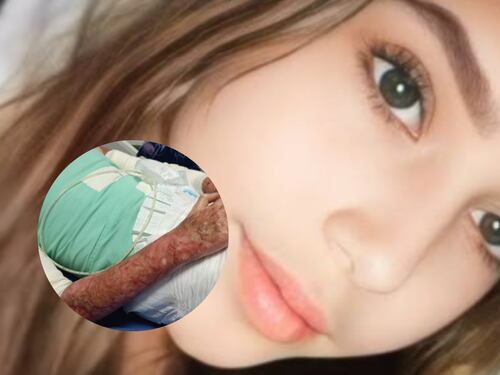 Brutal: Quinceañera fue quemada por otros menores dentro de una perfumería artesanal, tiene el 80 % del cuerpo afectado
