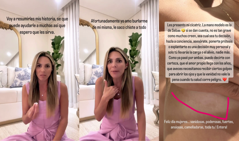 Mabel Cartagena habló de su experiencia con las prótesis mamarias