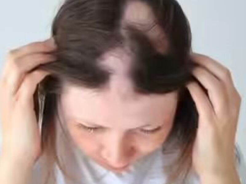 Alopecia areata: la enfermedad autoinmune que Colombia aún confunde con un problema estético