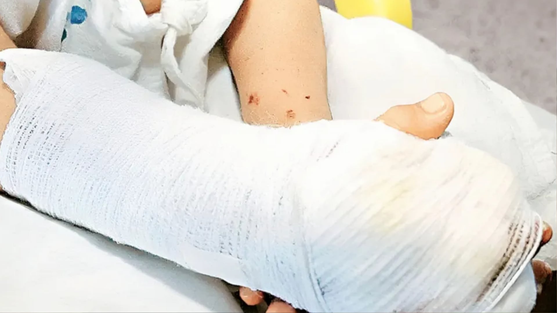 Quemaduras con líquidos calientes las que más secuelas dejan.