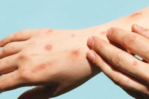 Alerta sanitaria en Bogotá: Detectan primer caso de la variante clado Ib de mpox