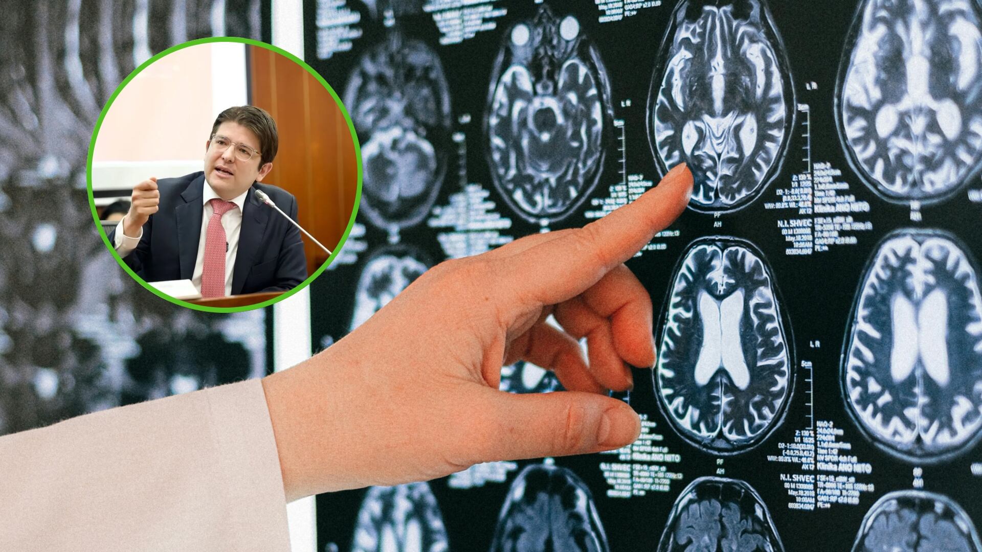 Qué es un edema cerebral y por qué afecta a Miguel Uribe (Foto: Pexels y redes sociales)