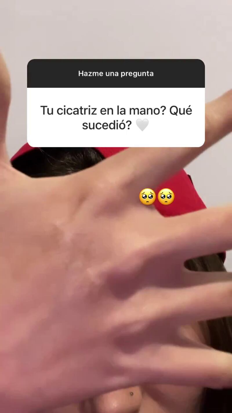 Shaira mostró la cicatriz de su mano