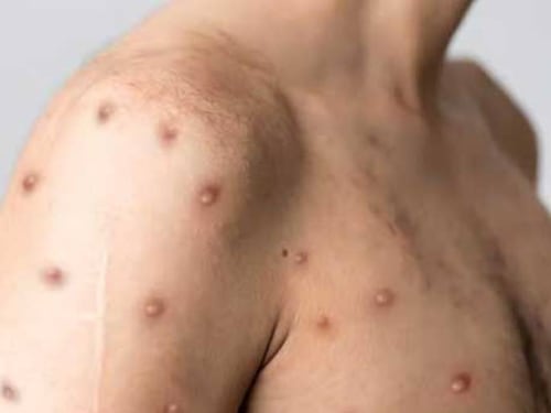 Detectan en Antioquia el primer caso de variante viruela símica en Colombia: esto dijo MinSalud