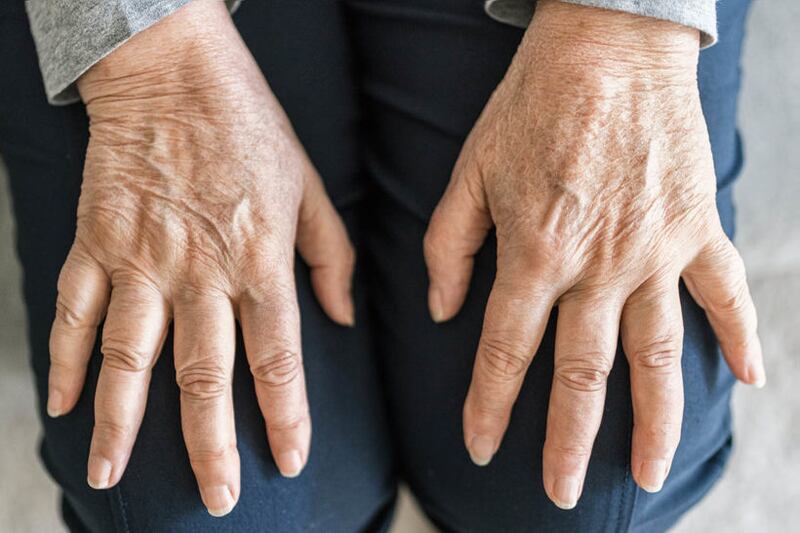 La osteoporosis es una enfermedad que hace que los huesos se debiliten y se vuelvan frágiles, en tal medida que una caída o hasta una leve tensión, como agacharse o toser, pueden causar una fractura. Foto: SPED.