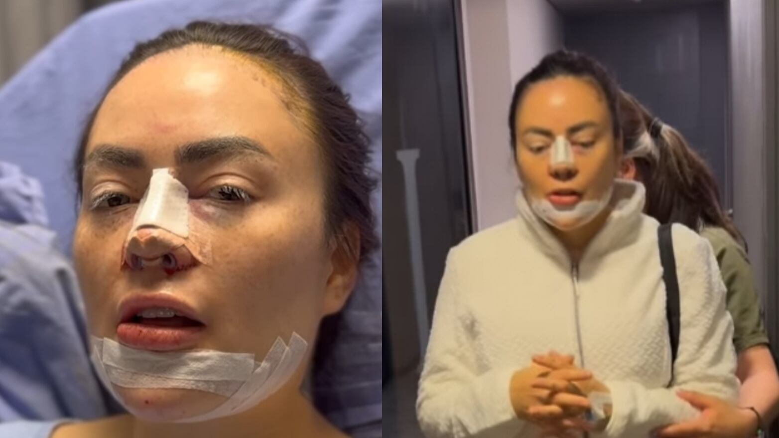 ‘Epa Colombia’ volvió a someterse a nuevas cirugías estéticas en su rostro