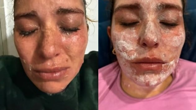 Foto de la joven herida con quemaduras fritando un buñuelo en Navidad.