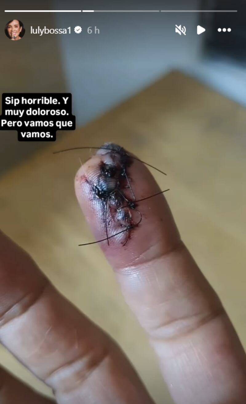Luly Bossa mostró el delicado estado de su dedo tras cortarse en MasterChef