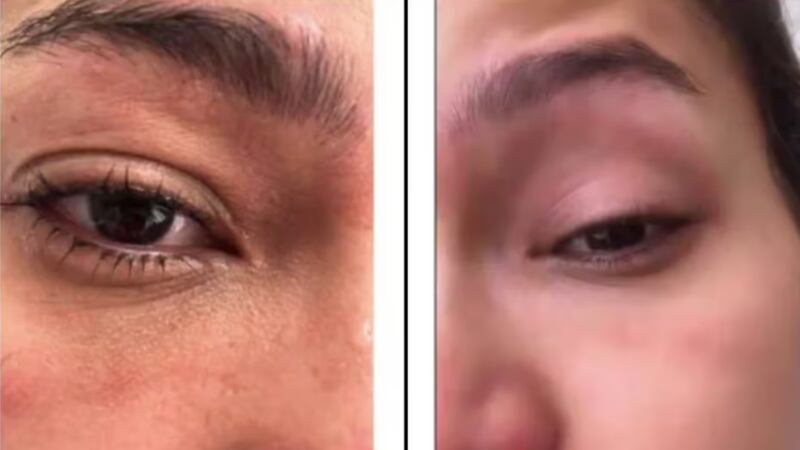 Así quedó el rostro de Andrea Tovar tras sufrir el accidente en su casa