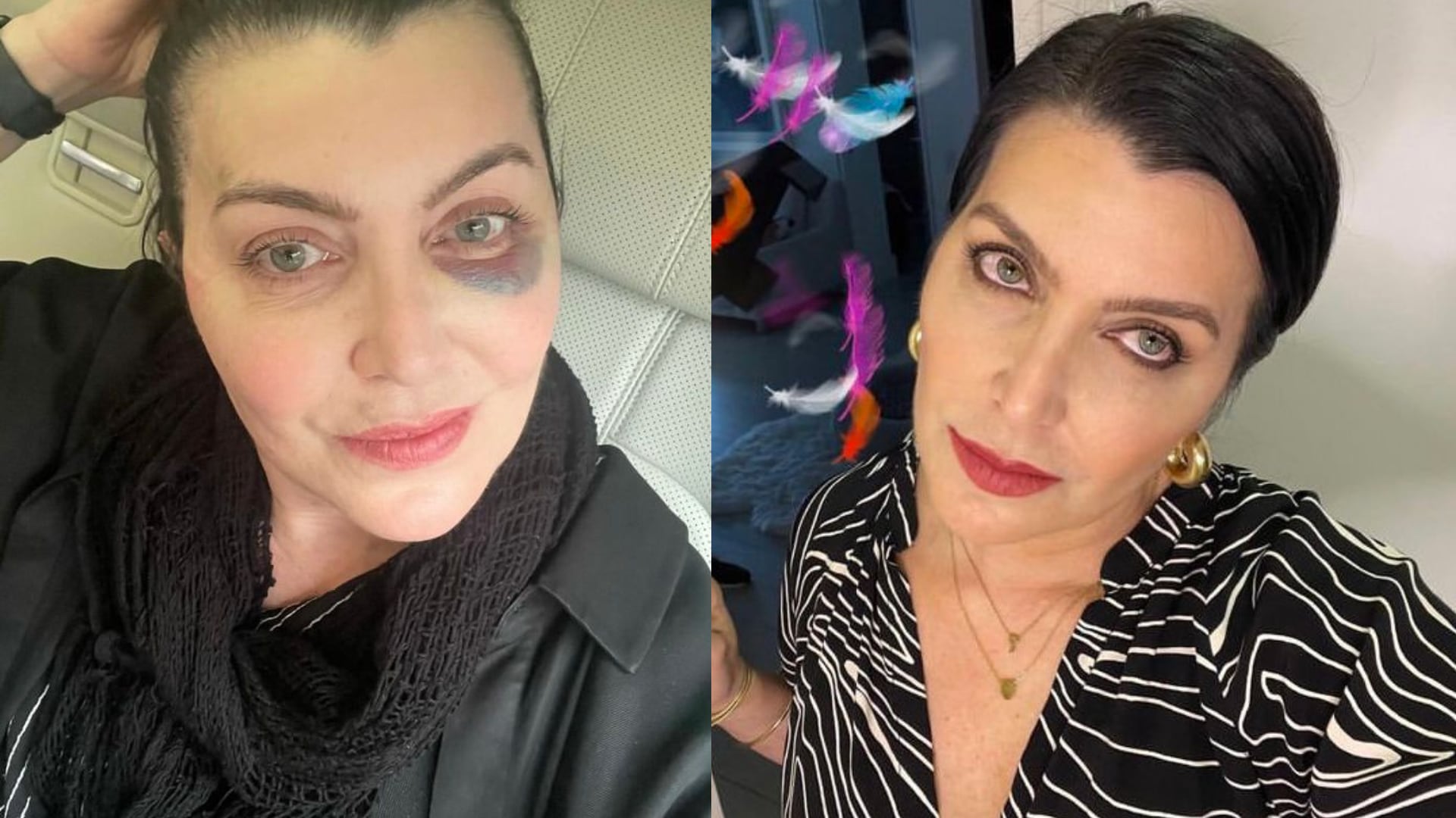 Isabella Santodomingo cirugía de su oido