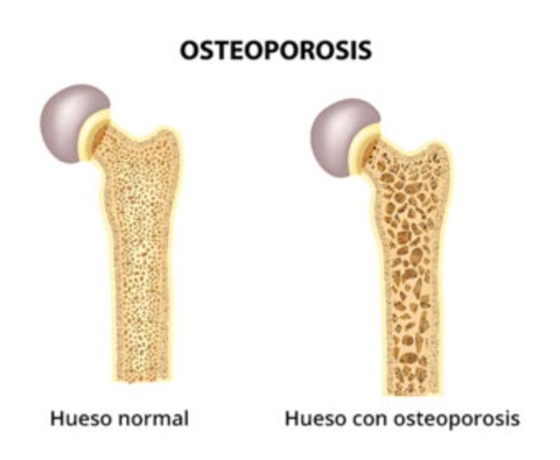La osteoporosis es una enfermedad que hace que los huesos se debiliten y se vuelvan frágiles, en tal medida que una caída o hasta una leve tensión, como agacharse o toser, pueden causar una fractura. Foto: GeoSalud.