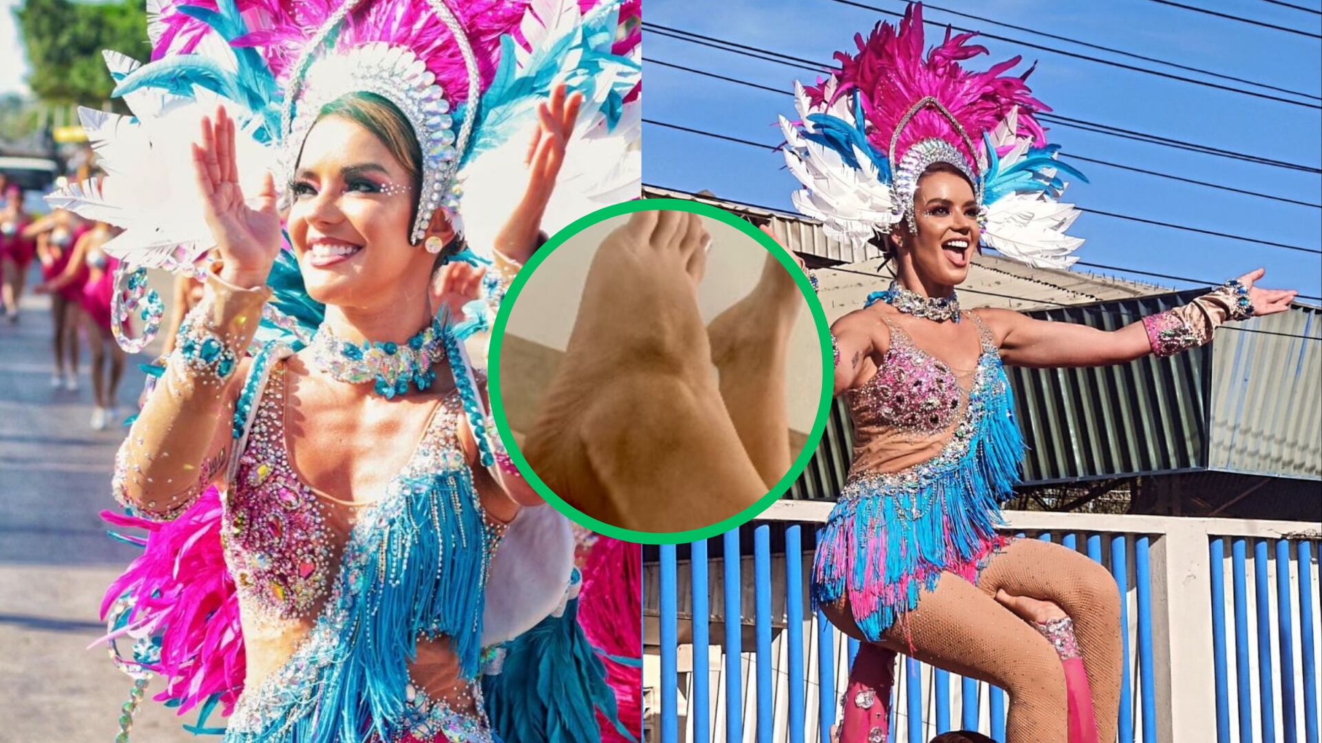 Elianis Garrido mostró las heridas que se hizo en el Carnaval de Barranquilla